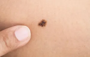 Всеукраїнський День боротьби з меланомою